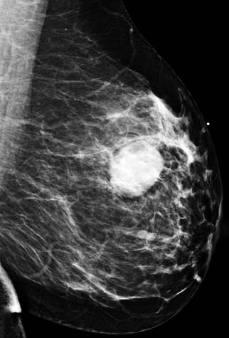 Digital mammogram