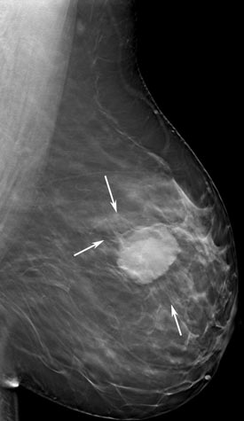 Breast tomosynthesis image.