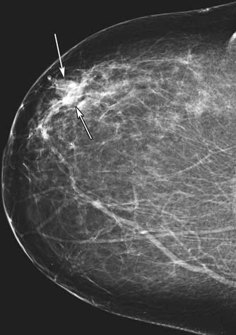 Mamograma digital del seno derecho de una paciente