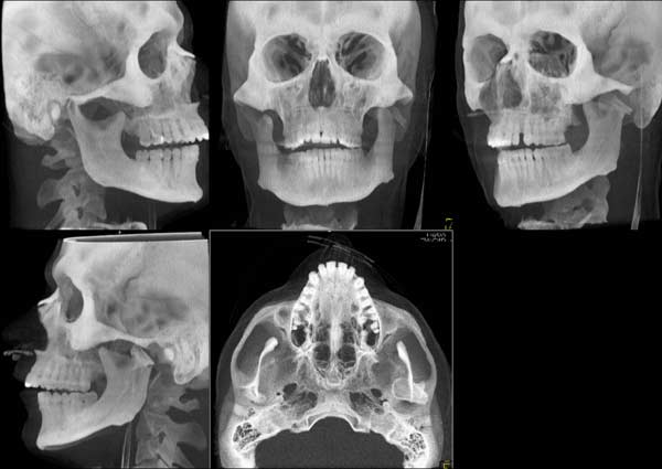 Una imagen 3-D derivada de una exploración por TAC describe un proceso de fractura condiloidea.