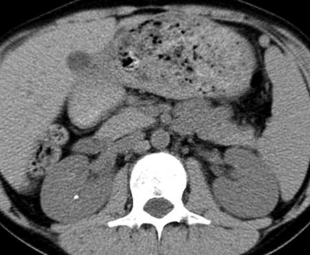 Multi-detector CT scan of a child's kidney.