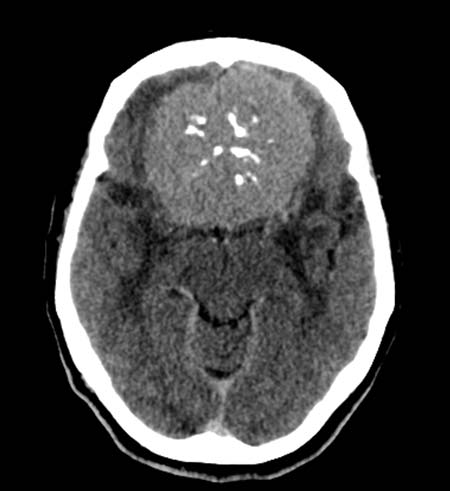  Una tomografía computarizada de la cabeza que muestra un meningioma.