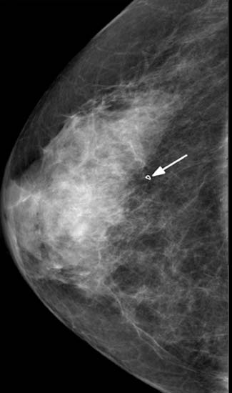 Stereotactic Breast Biopsy