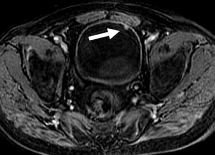 MRI of the bladder in a patient with hematuria.