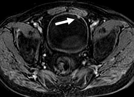 RM de vejiga en un paciente con hematuria.