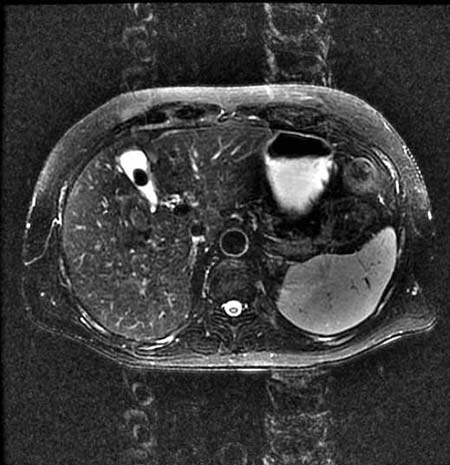 MRI of the abdomen showing a gallstone.