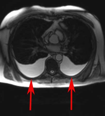 Chest MRI showing pleural effusions