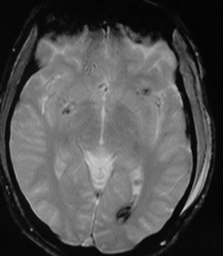 MRI showing microscopic lesions in the brain.
