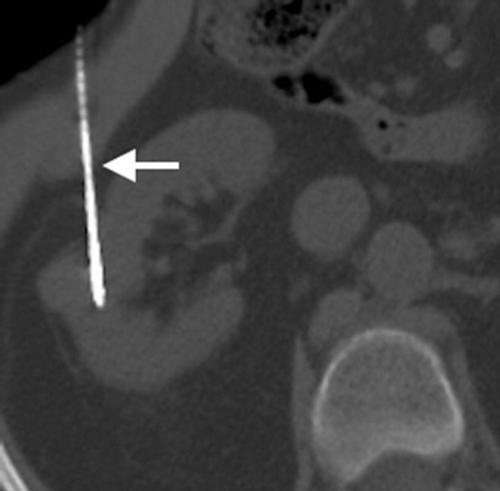 MRI que muestra aplicadores de microondas.