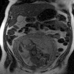 MRI - fetus