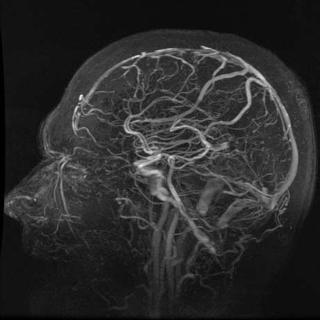 udtryk lede efter lugt Magnetic Resonance Angiography (MRA)
