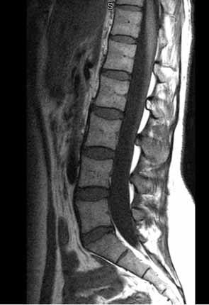 RMN normal de la columna lumbar