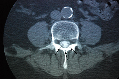 CT scan of a dural tube.