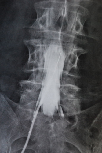 Image of a myelographic needle in the dural tube.