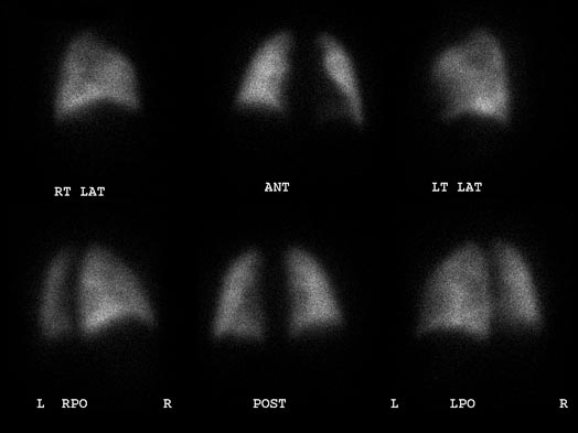 Normal VQ scan.