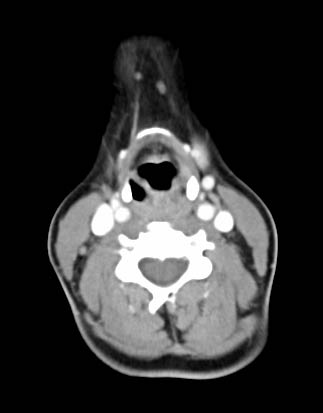 CT scan of the neck just above the vocal cords.