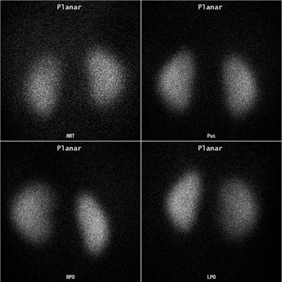 Nuclear medicine renal scintigraphy images.