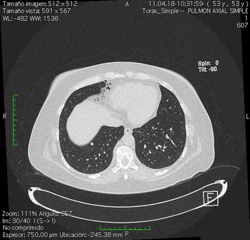 Imagen de TC que muestra un nódulo pulmonar (pulmón).