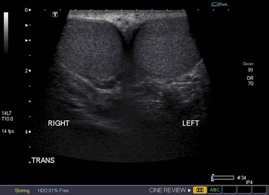 Ultrasound image of normal testes.