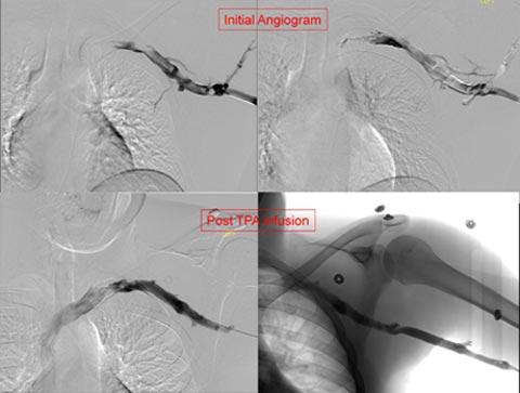 Angiogram