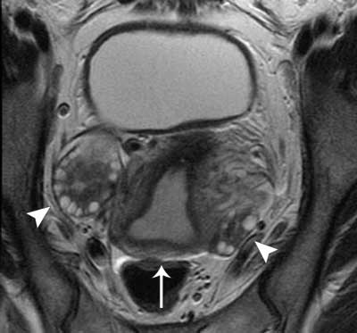 Resonancia magnética de la pelvis de una mujer que muestra el útero y los ovarios.