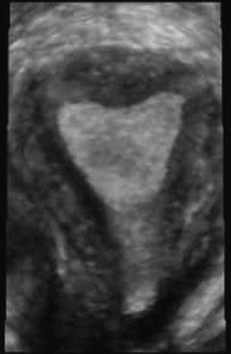 Ultrasound image of a patient's pelvis.