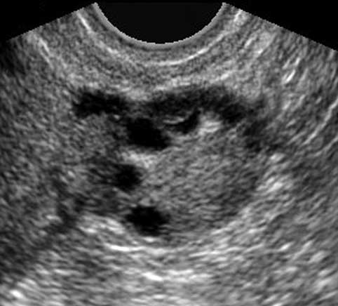 Pelvic ultrasound showing the ovary.