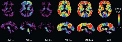 Imagen PET de sujetos normales, con deterioro cognitivo leve (DCL) y con enfermedad de Alzheimer.