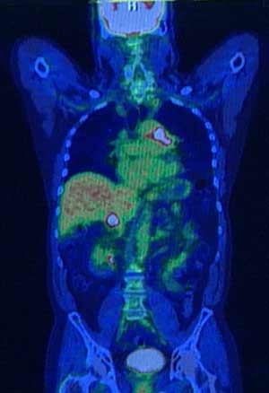 Positron Emission Tomography/Computed Tomography