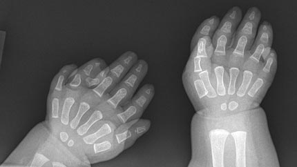 X-ray image showing bilateral polydactyly.