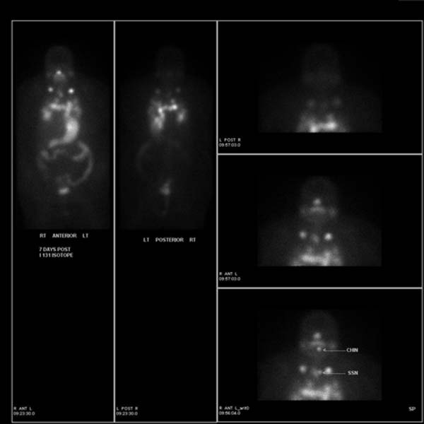 Diagnóstico I-123 de las imágenes del cuerpo entero no demuestran ningún foco anormal de actividad para sugerir metástasis. Las imágenes I-131 del cuerpo entero posteriores al tratamiento demuestran múltiples focos anormales de actividad consistente con metástasis extensas de los ganglios linfáticos y los pulmones. Estos descubrimientos fueron confirmados por imágenes TAC subsecuentes.