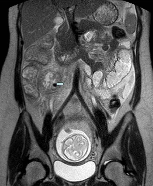 Resonancia magnética que muestra apendicitis perforada.