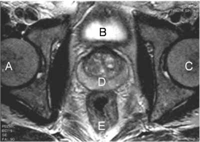 multiparametric mri prostate cpt code