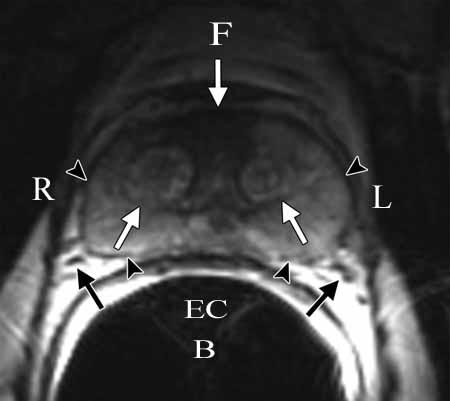  Resonancia magnética endorectal de la anatomía de la próstata utilizando un escáner clínico de RM.