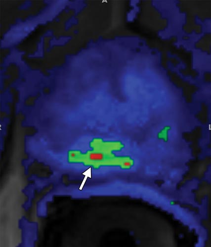MR image shows a perfusion abnormality in an area affected by cancer. 