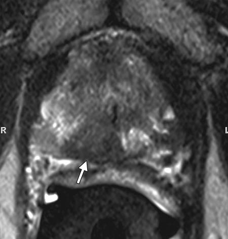 MRI in patient with prostate cancer. 