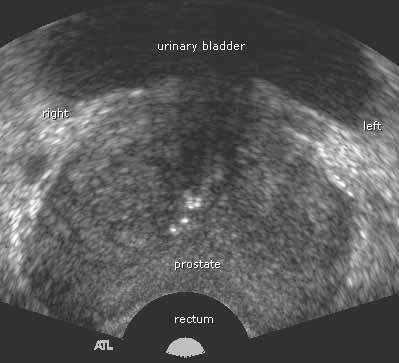 ecografía prostática transrectal