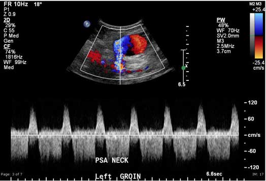  Imagen de ultrasonido que muestra un pseudoaneurisma.