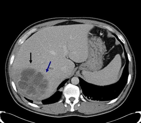 CT scan of the liver