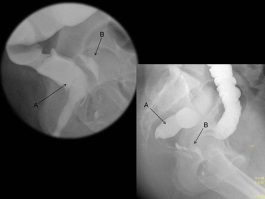 Imágenes de un enema por bario