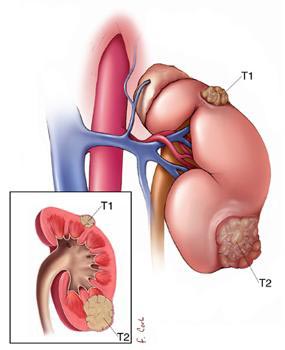Illustration of kidney tumors