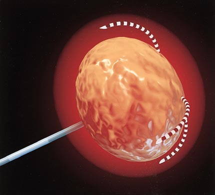 RFA - ablación.de tumores hepáticos (menos de 2 cm) 