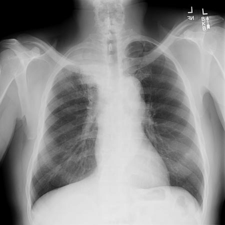 X-ray image of RUL Pancoast tumor. 