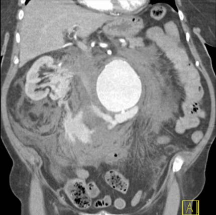 CT image: Ruptured abdominal aorta