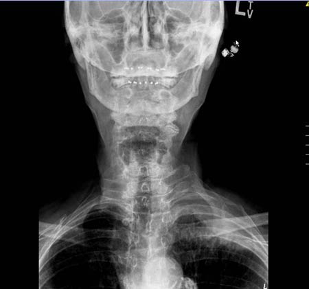Imagen de rayos X de la columna cervical 