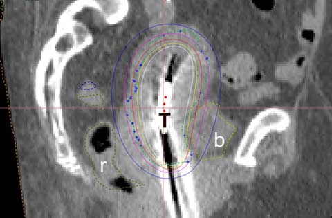 Planning CT for HDR brachytherapy 