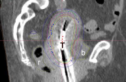 Planning CT for HDR brachytherapy