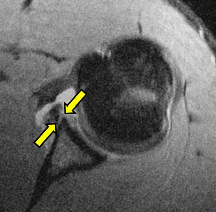 Shoulder MRI showing a tear of the anterior labrum.