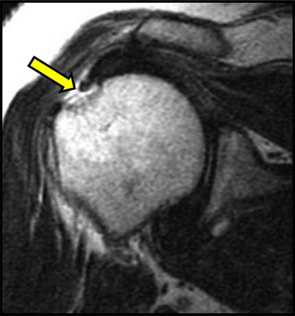 What Is Mri Of The Shoulder