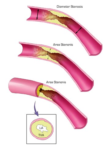 Ilustración de estenosis arterial cardíaco.